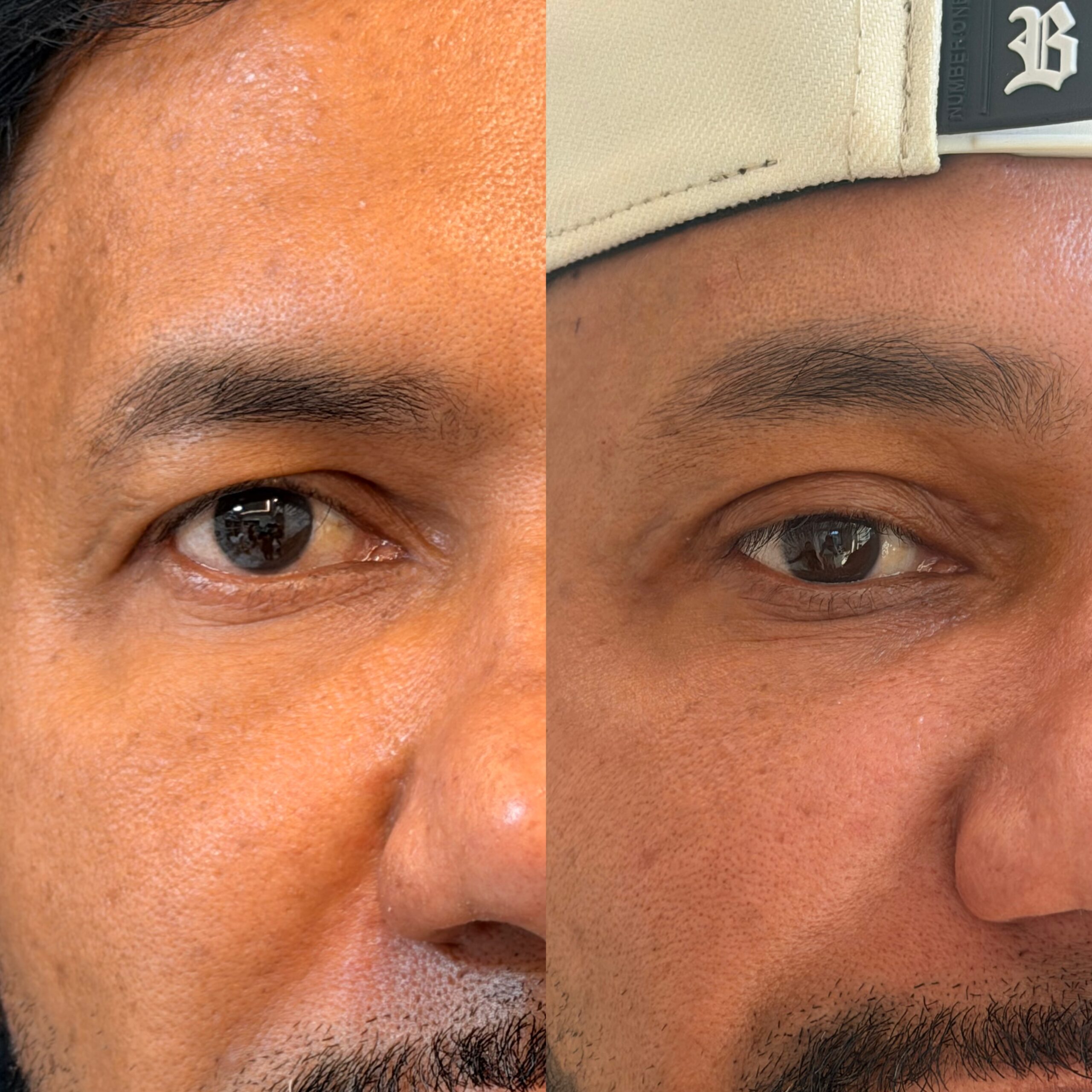 blefaroplastia em niteroi