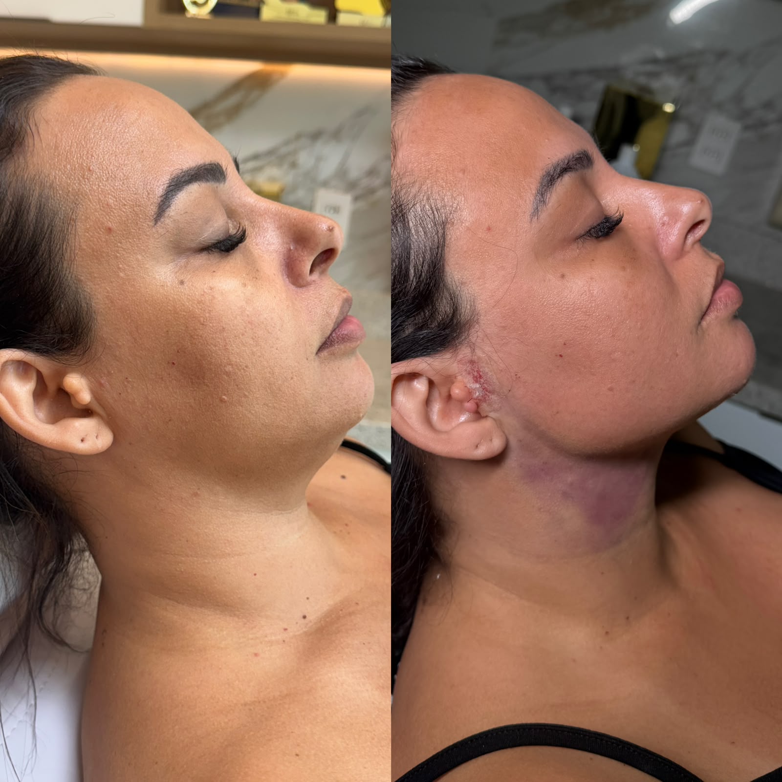 lipo de papada em niteroi